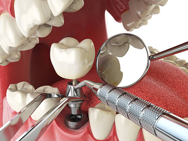 Best Chipped Tooth Repair Near Me  in Wakeeney, KS